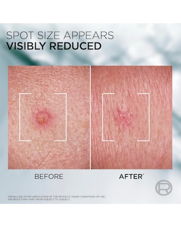 L'Oreal Men Expert Derma Control S.O.S Pimple Paste