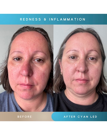 Sensse Elite LED Face Mask - 8 Light