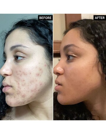 The INKEY Tranexamic Acid Serum