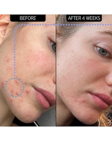 The INKEY Blemish Clearing Moisturiser